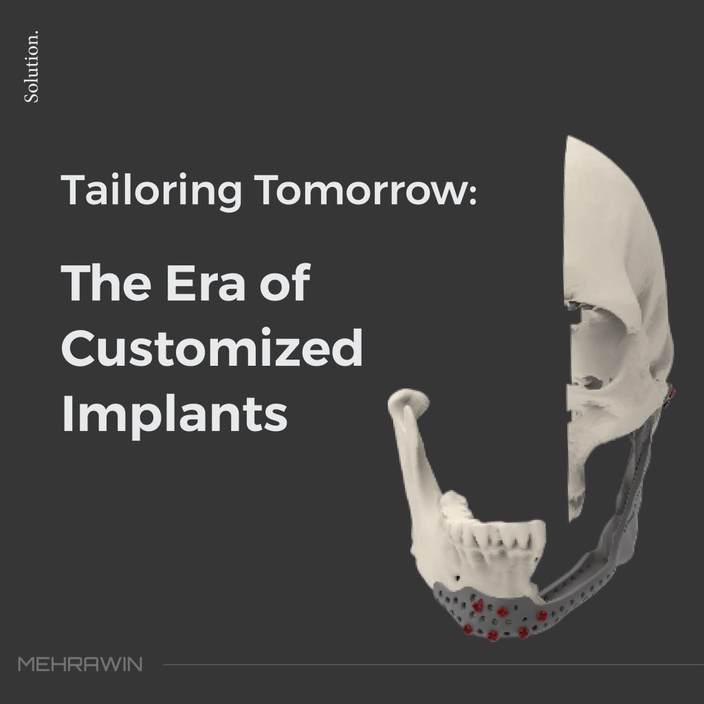 Tailoring Tomorrow: The Era of Customized Implants